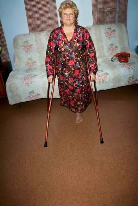 AI Video from prompt: A woman with the right leg amputated up to the u