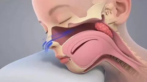 AI Video from prompt: Medical 3D animation. The child is 4-6 years old