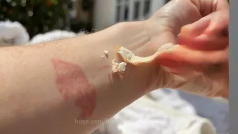Close-up of a hand peeling flakes of dry, sunburned skin from an arm.