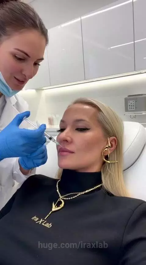 Lip Filler Disaster by iraxlab